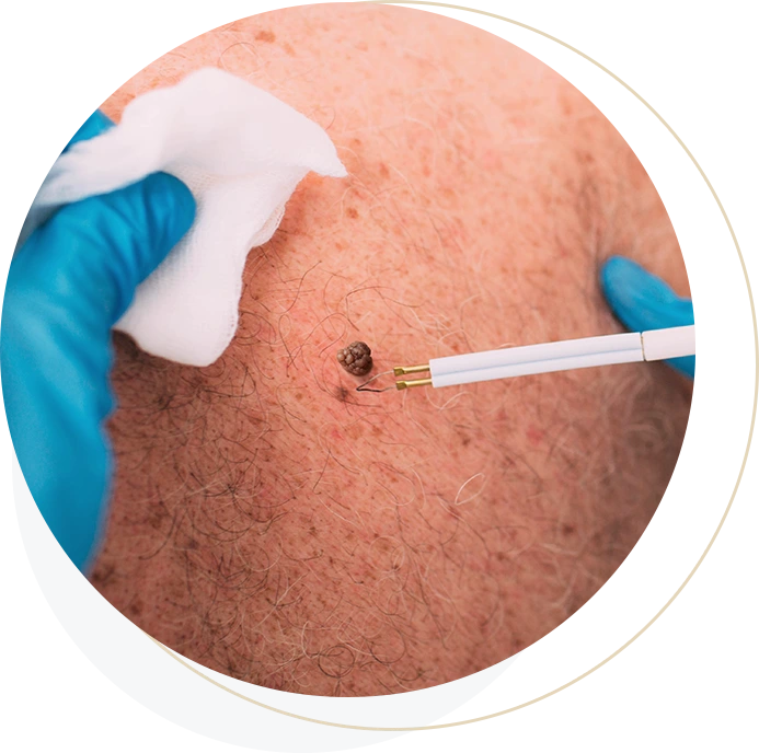 Melanoma_img06