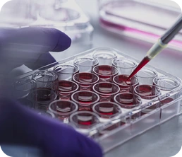 MultipleMyeloma_img04_01